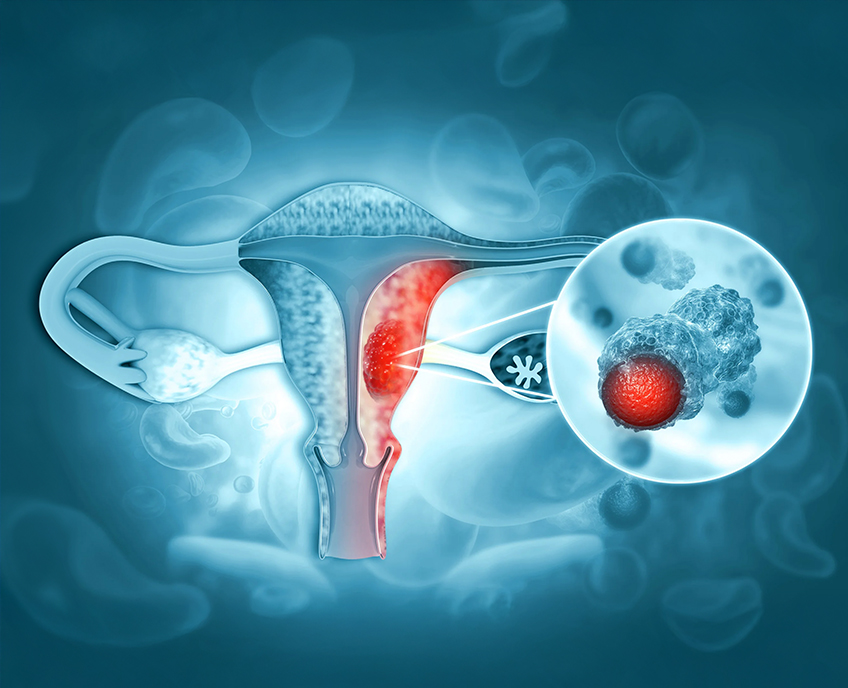 Gynecological Oncology